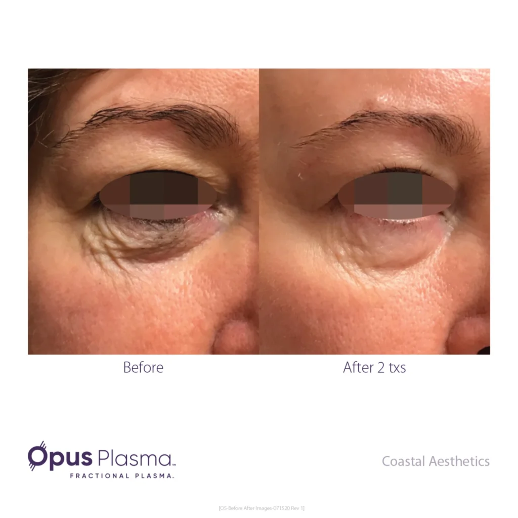 Opus Plasma results