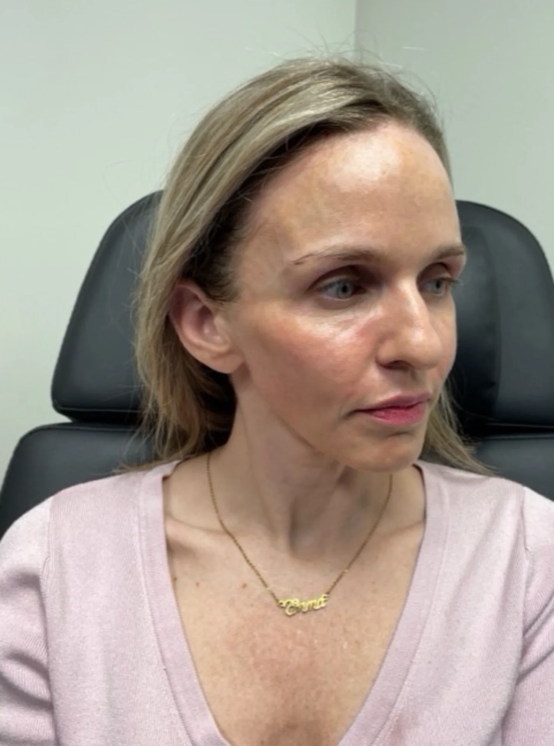 Cheek Fillers Park City